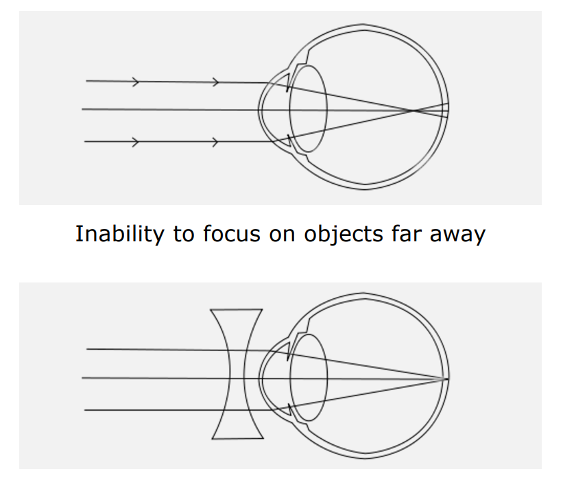 Myopia Correction