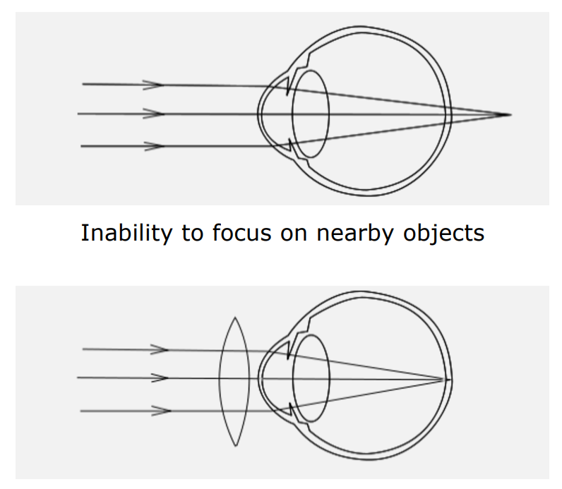 Hyperopia Correction